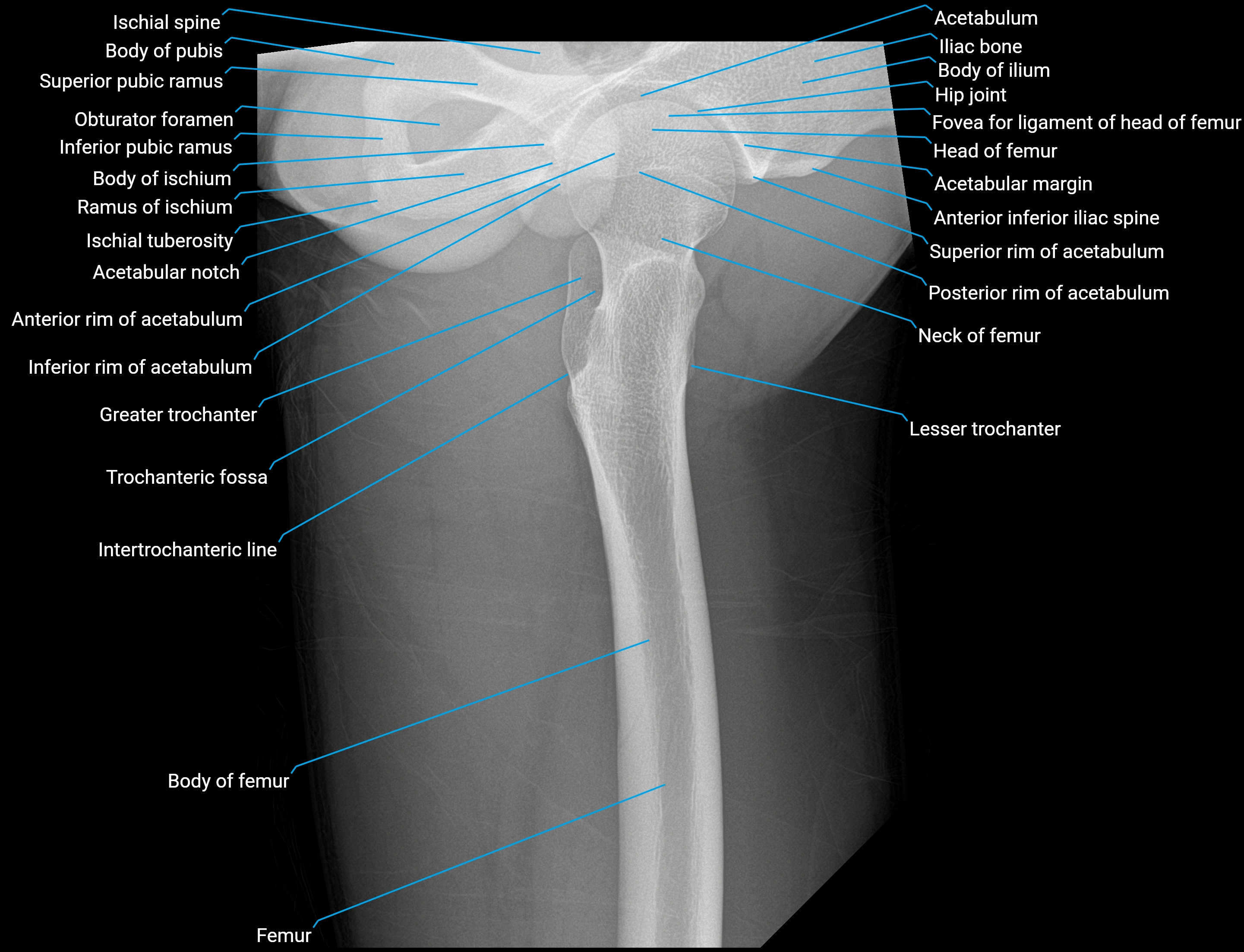 X ray femur lateral anatomy labelled image upper.webp